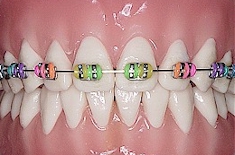 braces3_coloured